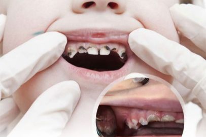 Çocuklarda diş sağlığı ve hijyen önerileri
