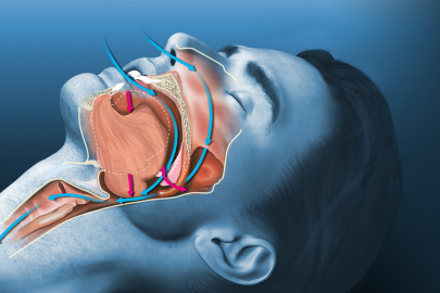 Uyku apnesi: Belirtileri, tanısı ve tedavi yöntemleri