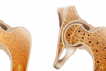 Osteoporoz risk faktörleri: Genetik, yaş ve yaşam tarzının rolü